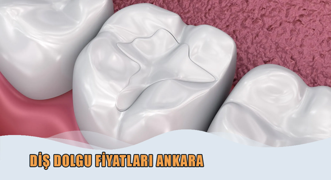 Diş Dolgu Fiyatları Ankara