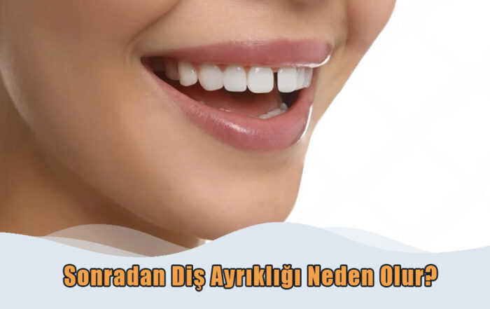 Sonradan Diş Ayrıklığı Neden Olur?