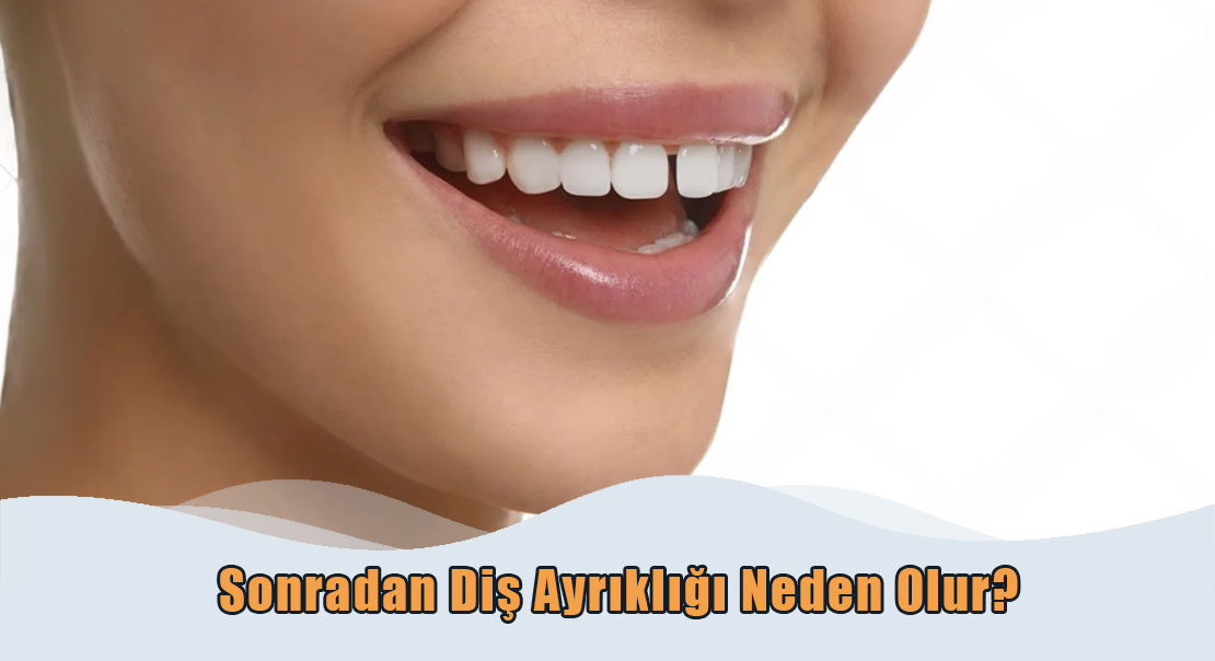 Sonradan Dis Ayrıkligi Sonradan Diş Ayrıklığı Neden Olur?