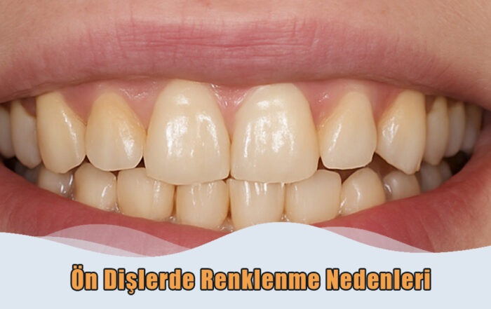 ön dişlerde renklenme nedenleri