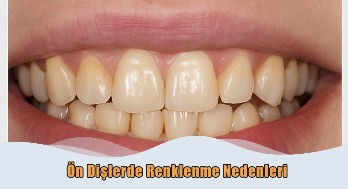 ön dişlerde renklenme nedenleri