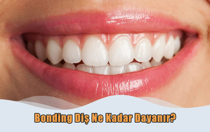 Bonding Diş Ne Kadar Dayanır?