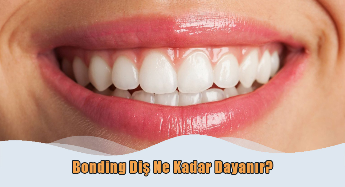 Bonding Diş Ne Kadar Dayanır?