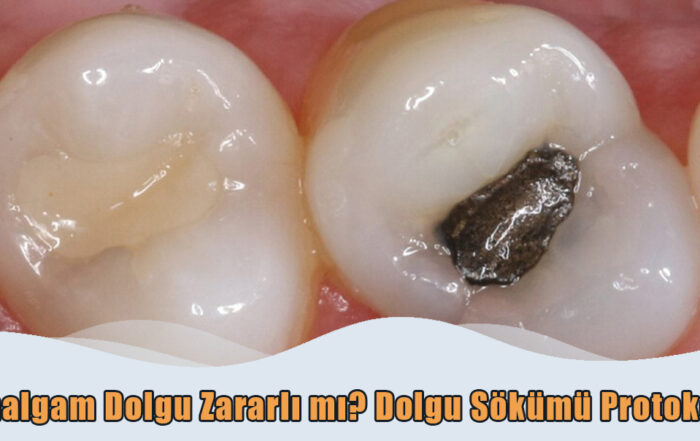 Amalgam Dolgu Sökümü Protokolü