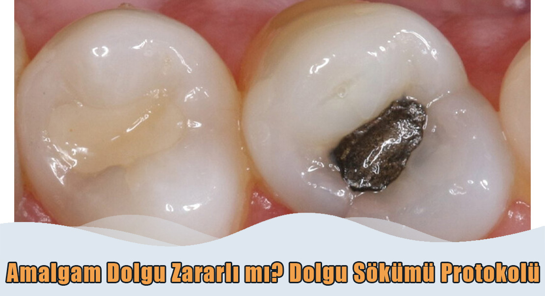Amalgam Dolgu Sökümü Protokolü