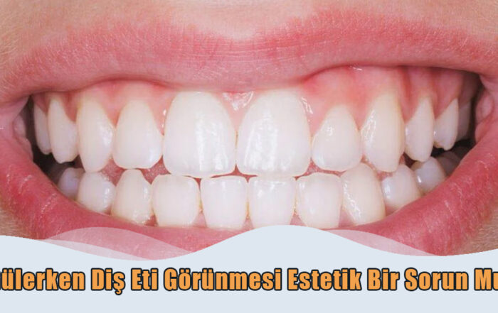 Gülerken Diş Eti Görünmesi