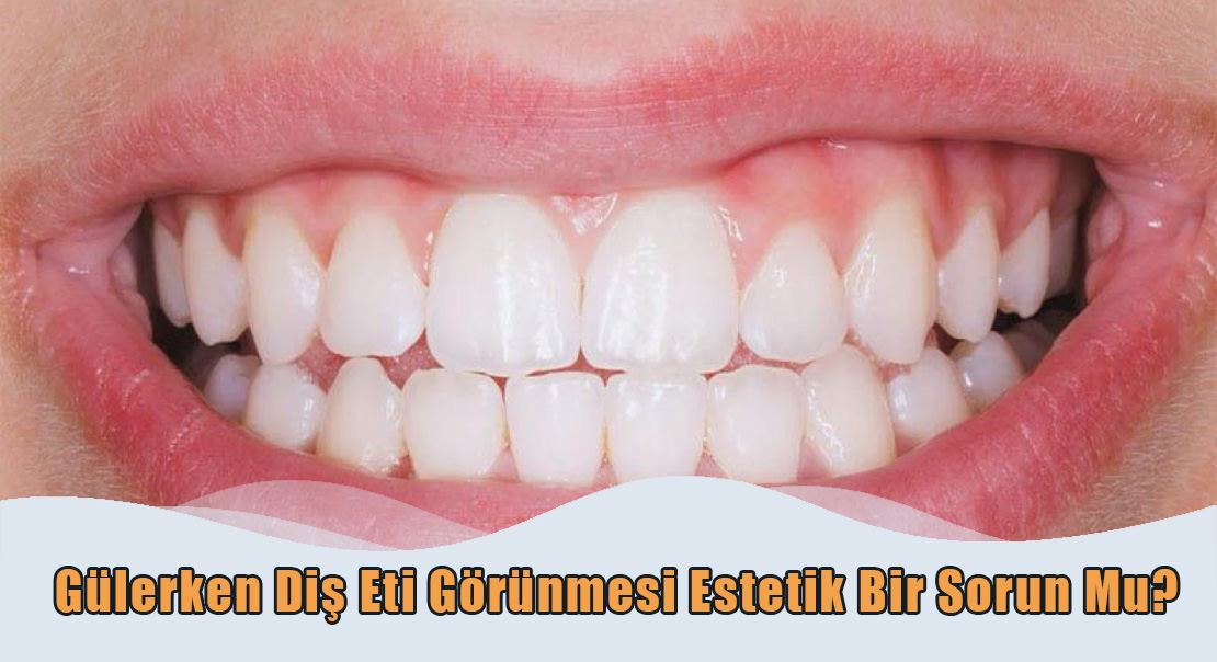 Dis-Eti-gorunmesi Gülerken Diş Eti Görünmesi