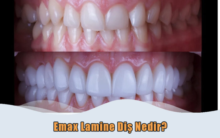 Emax Lamine Diş Nedir?