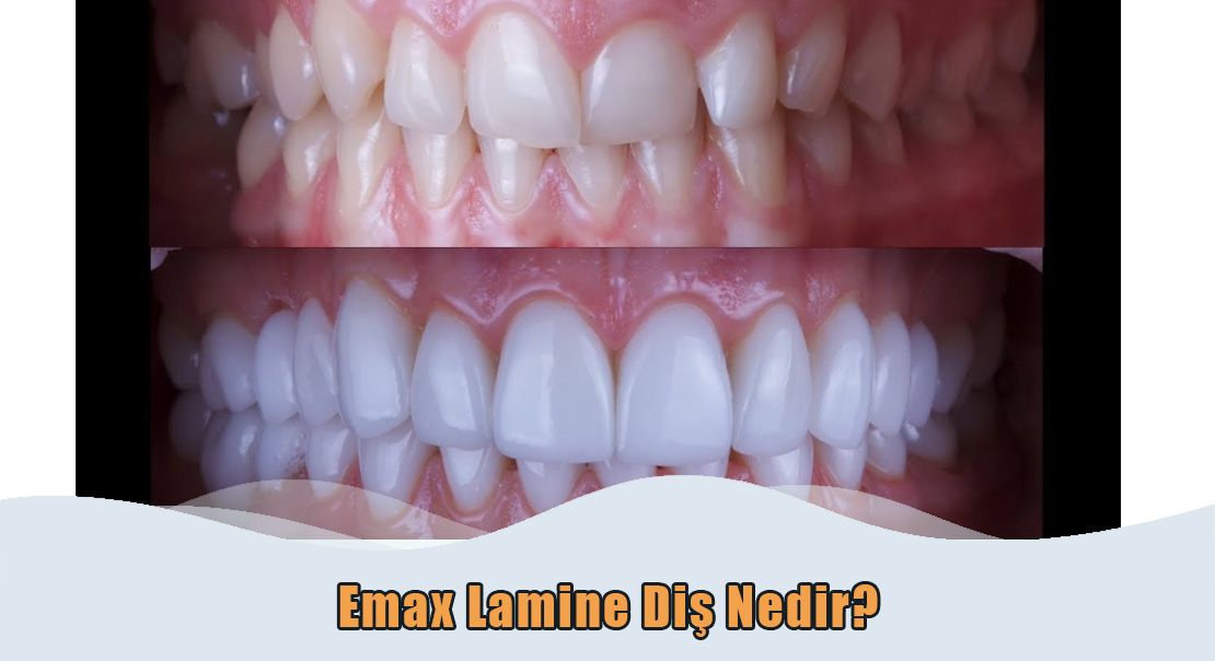 Emax Lamine Dis Emax Lamine Diş Nedir?