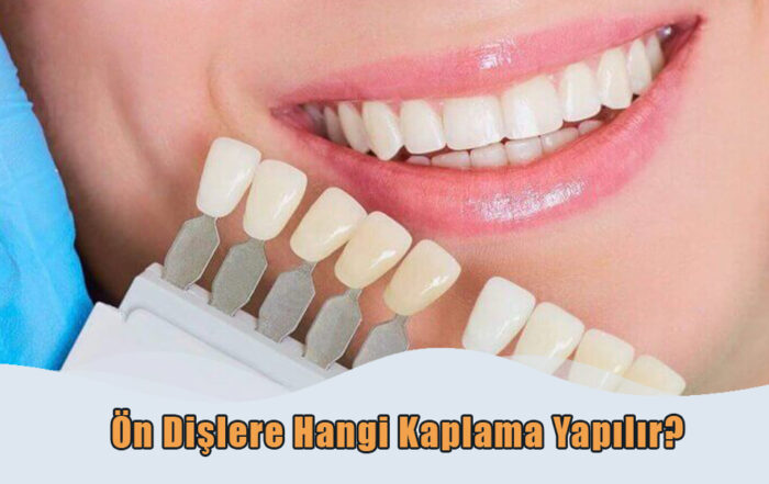 Ön Diş Kaplama çeşitleri