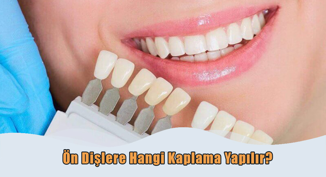 Ön Diş Kaplama çeşitleri