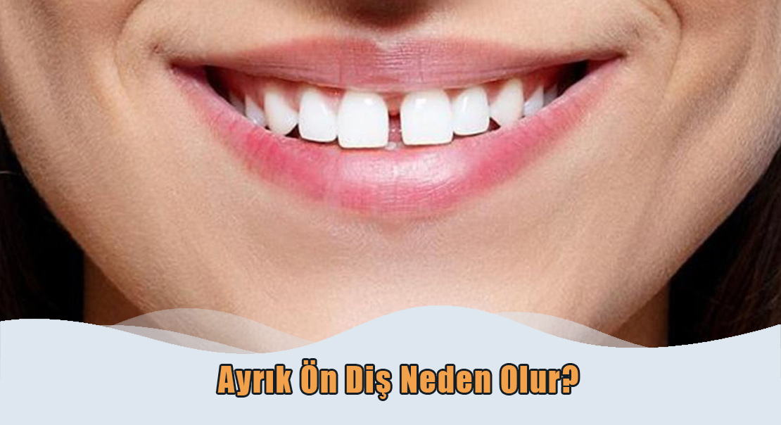 Ankara Ayrık Ön Diş Tedavisi