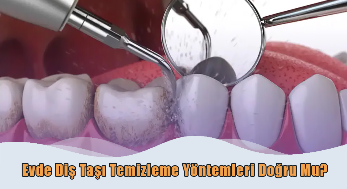 Evde Diş Taşı Temizleme