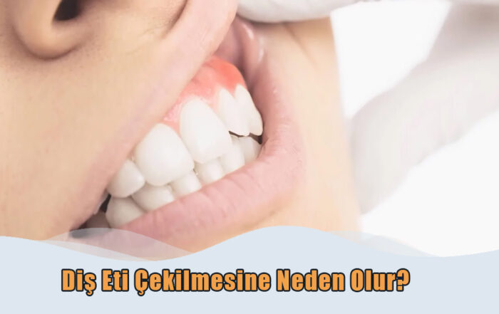 Diş Eti Çekilmesi