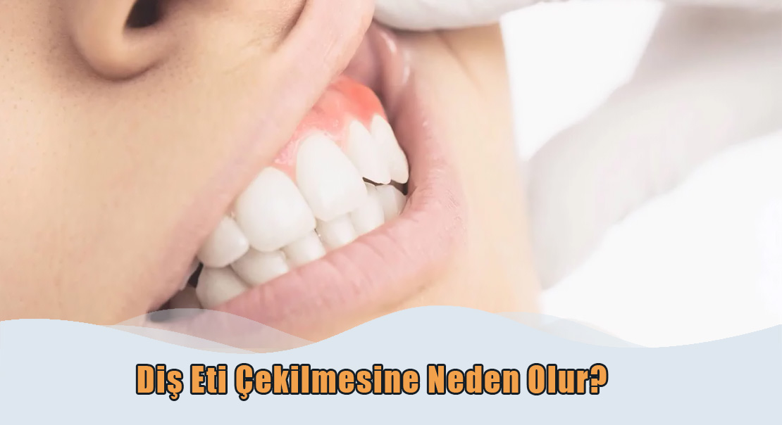 Diş Eti Çekilmesi