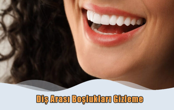 Diş Arası Boşlukları Gizleme
