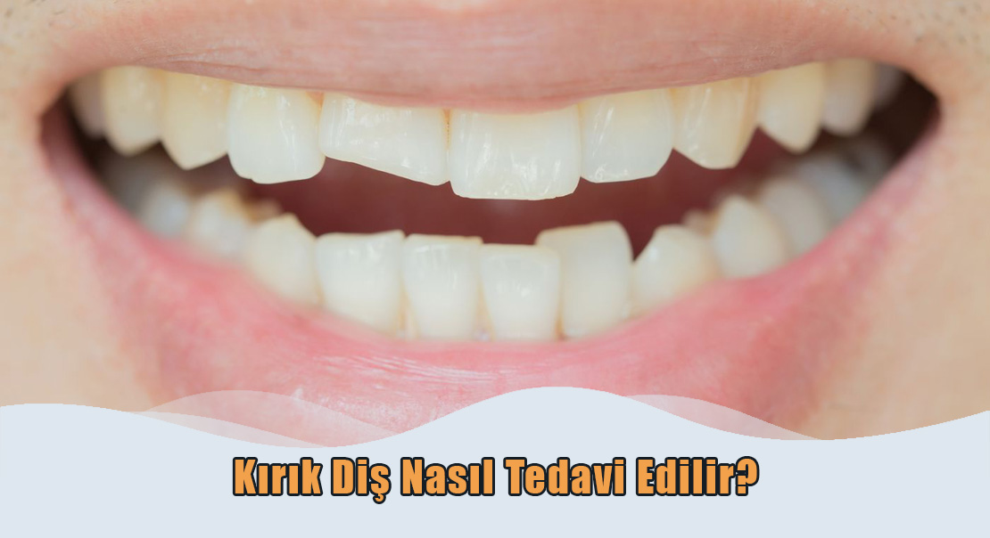 Kırık Diş Nasıl Tedavi Edilir?