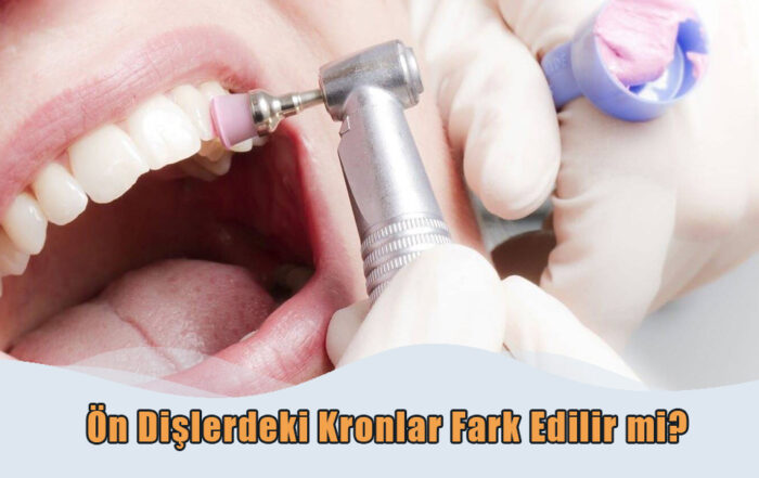 Ön Dişlerdeki Kronlar Fark Edilir mi?