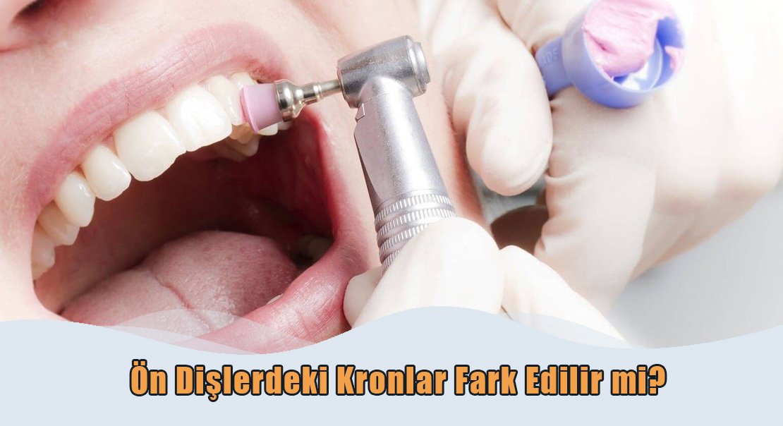 Ön Dişlerdeki Kronlar Fark Edilir mi?