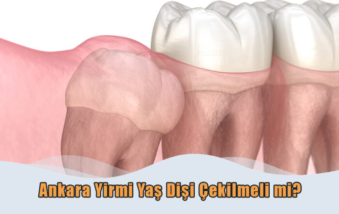 Ankara Yirmi Yaş Dişi Çekilmeli mi? 