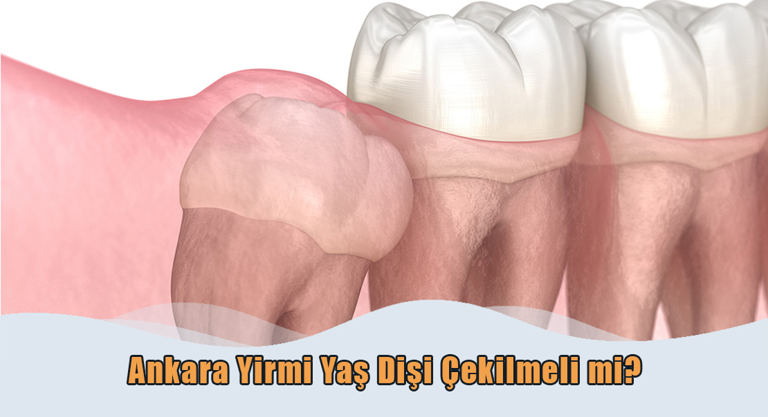 Ankara Yirmi Yaş Dişi Çekilmeli mi?
