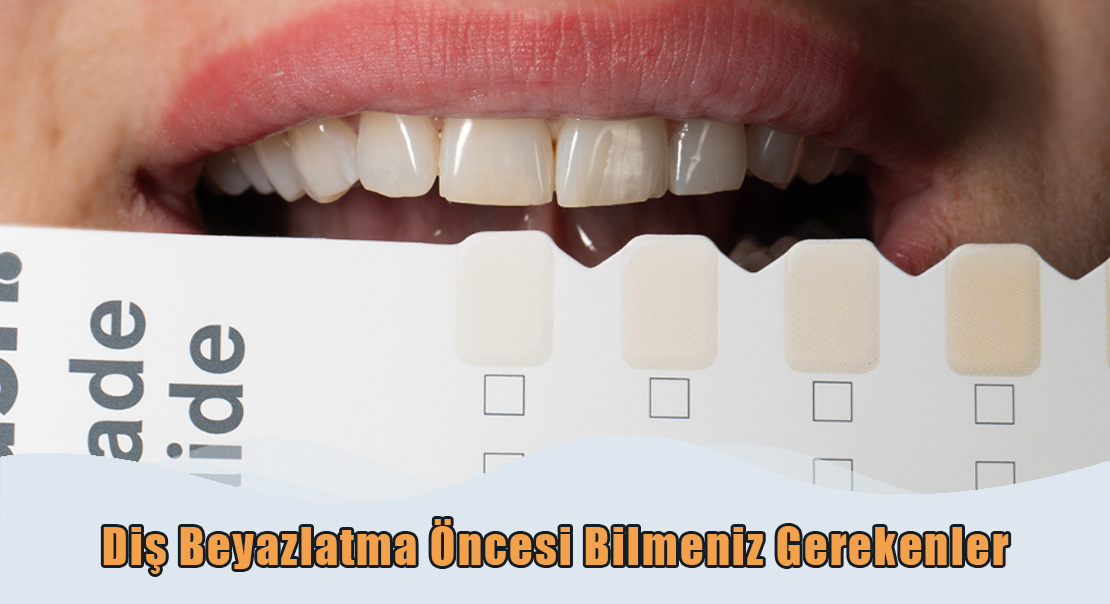 Diş Beyazlatma Öncesi
