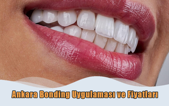 Ankara Bonding Uygulaması ve Fiyatları