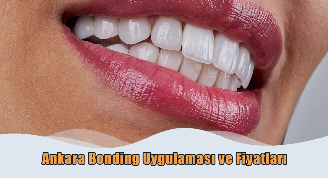 Ankara Bonding Uygulaması ve Fiyatları