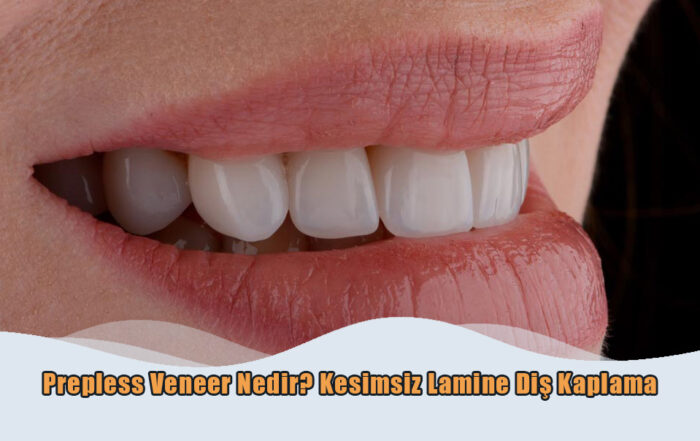 Prepless Veneer Nedir?