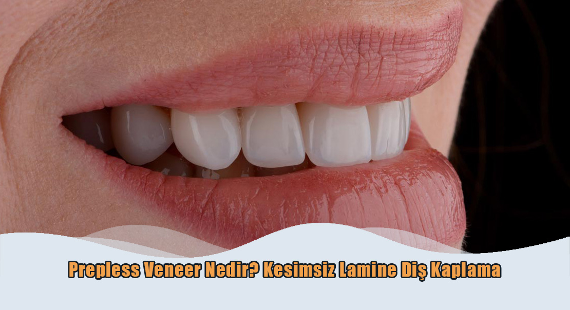 Prepless Veneer Nedir?