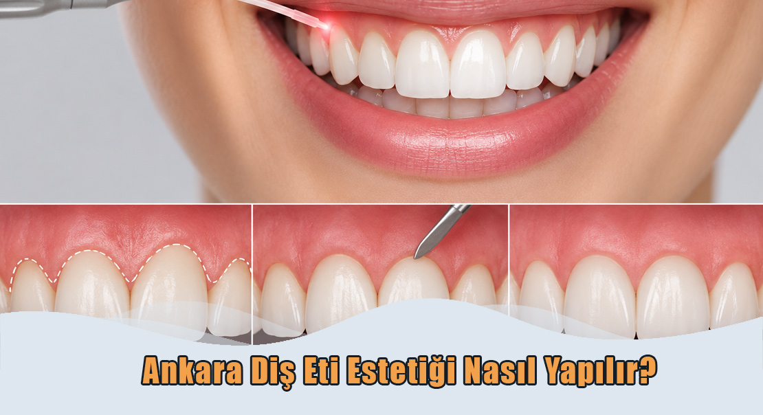 Ankara Diş Eti Estetiği Nasıl Yapılır?