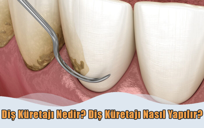 Diş Küretajı Nedir?