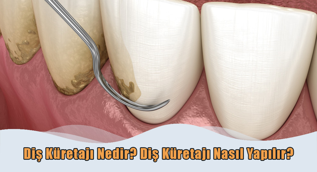 Diş Küretajı Nedir?