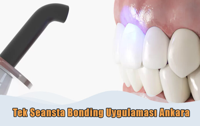 Tek Seansta Bonding Ankara