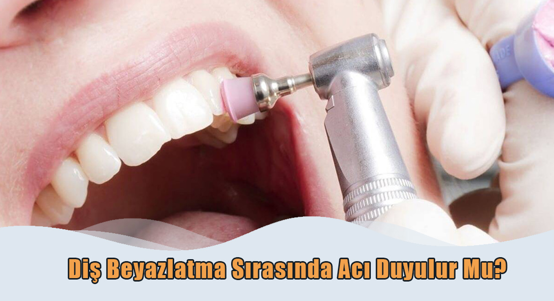 Diş Beyazlatma Sırasında Acı