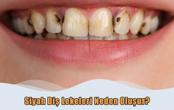 Siyah Diş Lekeleri Neden Oluşur?