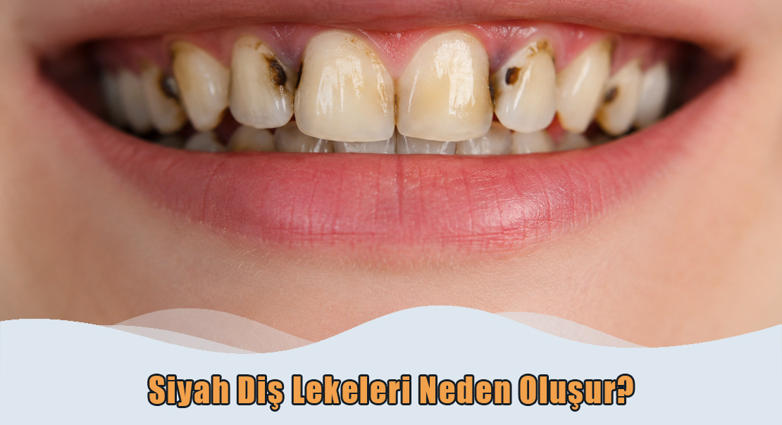 Siyah Diş Lekeleri Neden Oluşur?