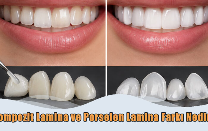 Kompozit Lamina ve Porselen Lamina Farkı Nedir?