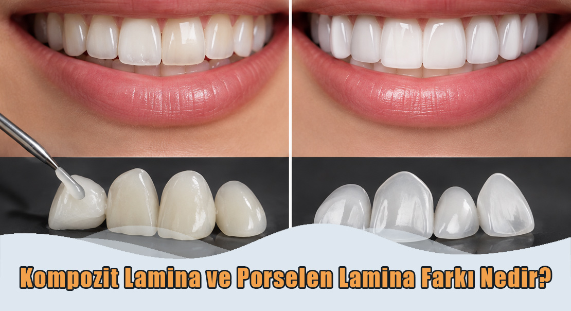Kompozit Lamina ve Porselen Lamina Farkı Nedir?