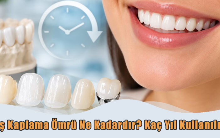 Diş Kaplama Ömrü Ne Kadardır?
