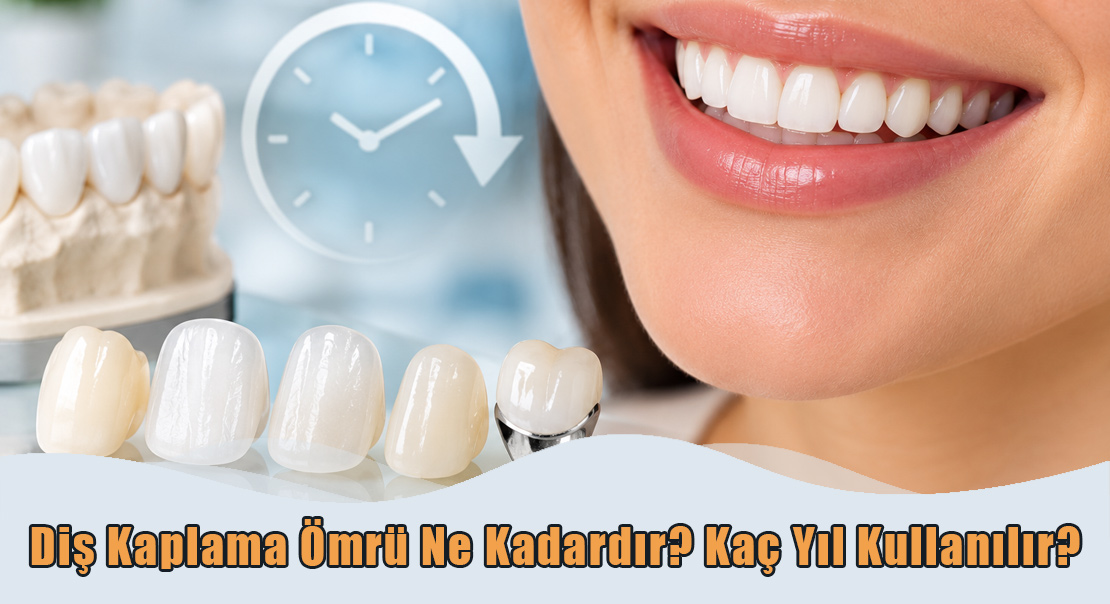 Diş Kaplama Ömrü Ne Kadardır?