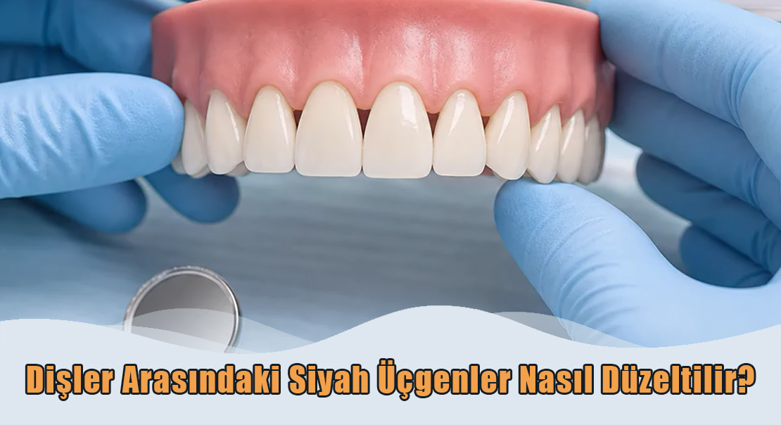 Dişler Arasındaki Siyah Üçgenler Dişler Arasındaki Siyah Üçgenler Nasıl Düzeltilir?