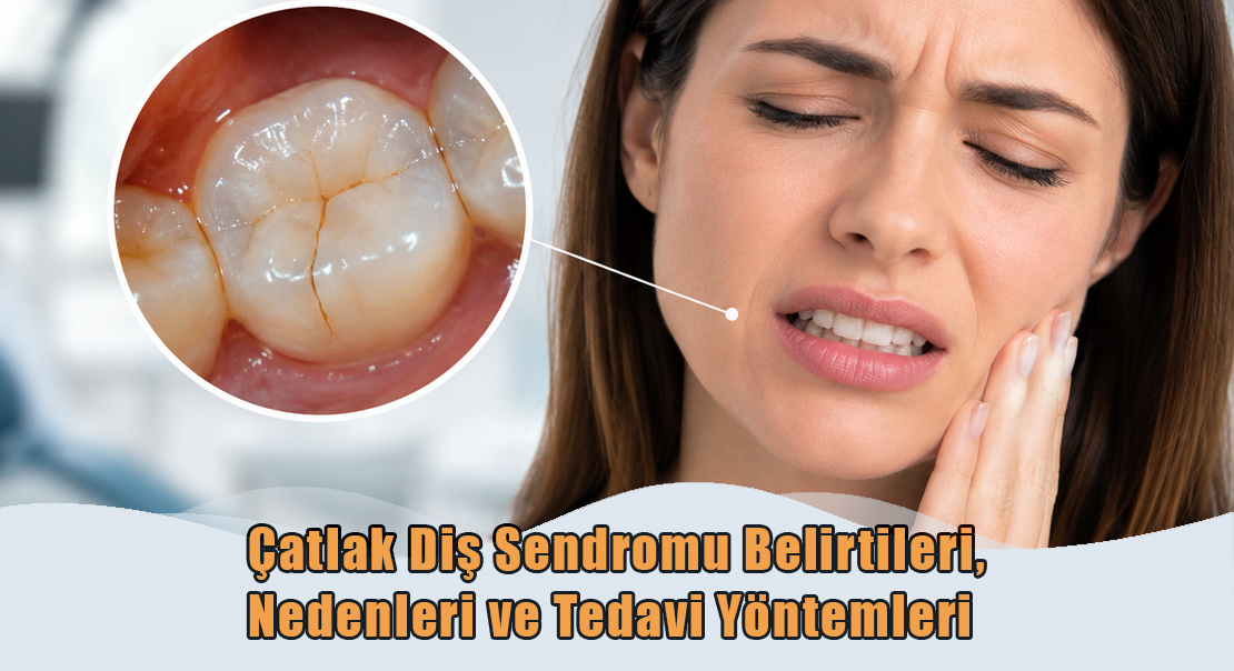 Çatlak Diş Sendromu Belirtileri